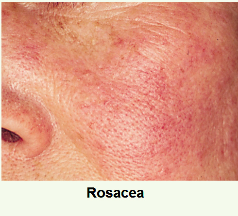 érzékeny bőr, bőrpír, érzékenység, rosacea,  cuperosa, lángoló bőr, bőrnyugtatás, érzékeny bőrre