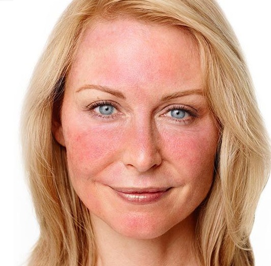 sensitive skin, rosacea, cuperosa, Algotherm,  Algosensi